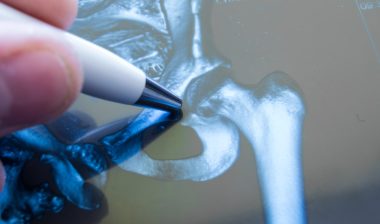 Accolade-hip-replacement-lawsuit
