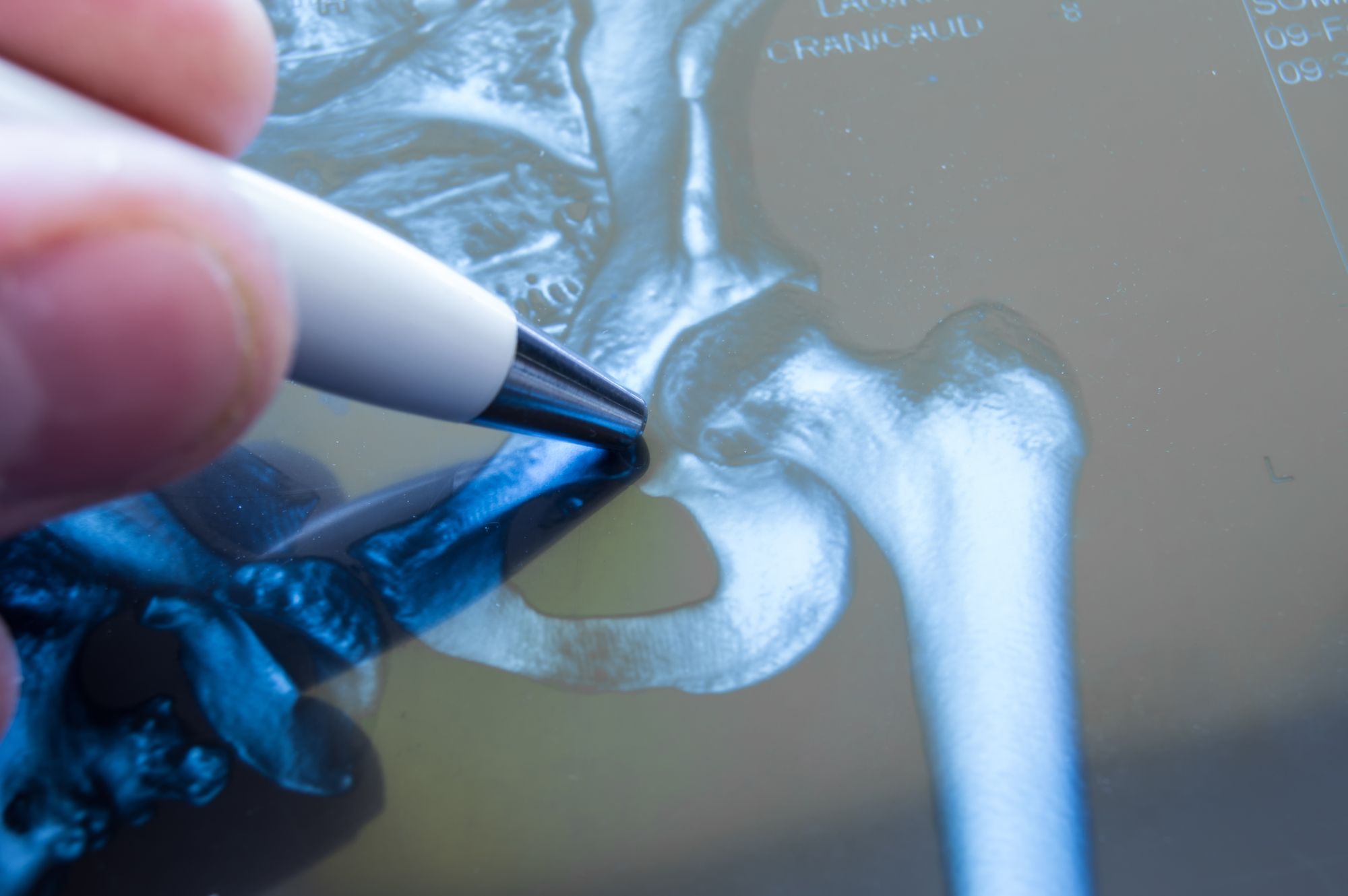 Accolade-hip-replacement-lawsuit