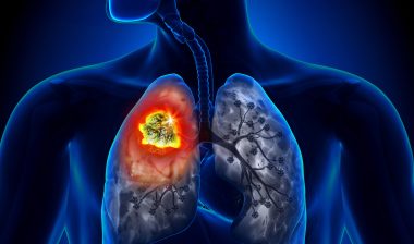 asbestos-related-disease