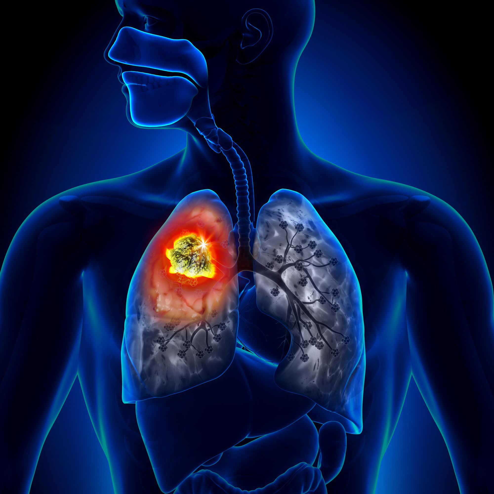 asbestos-related-disease