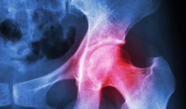Stryker-Accolade-hip-implant-lawsuit