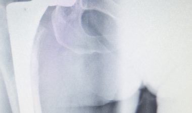 DePuy-ASR-hip-recall