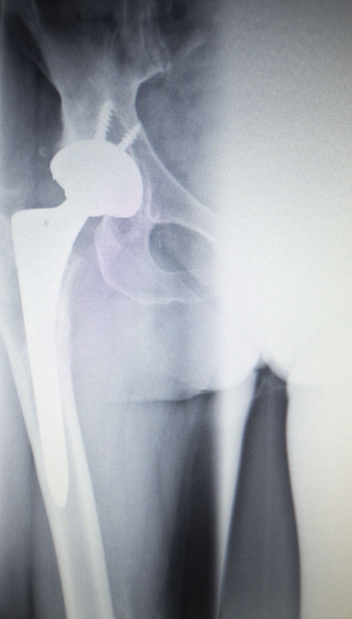 DePuy-ASR-hip-recall