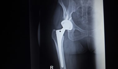 DePuy-hip-recall-compensation