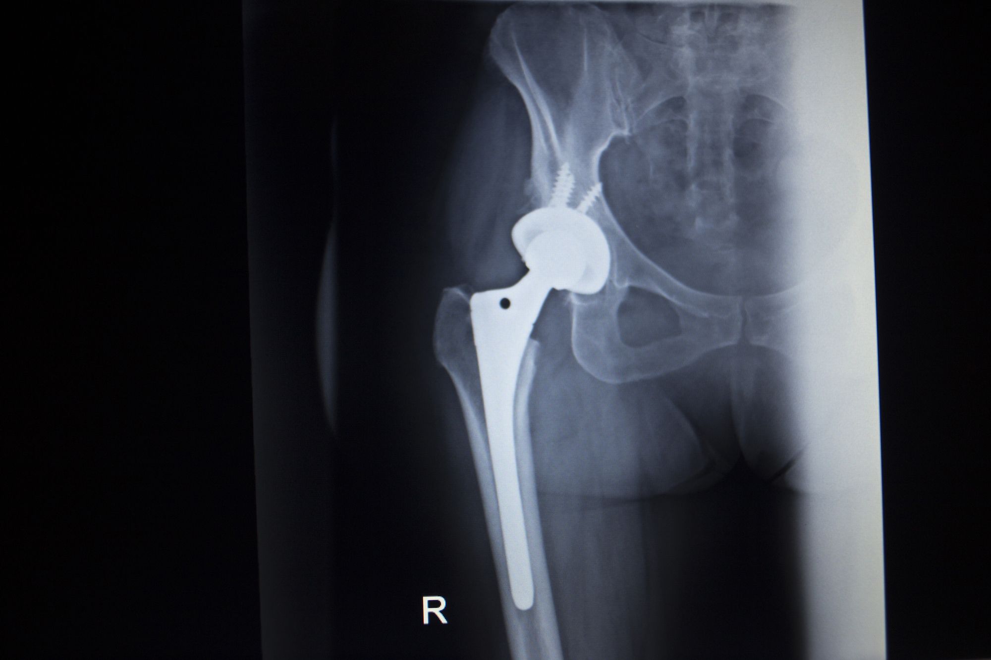 DePuy-hip-recall-compensation