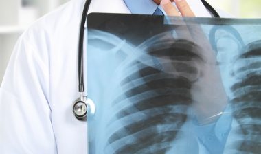 asbetos mesothelioma chest x-ray