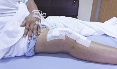 knee replacement
