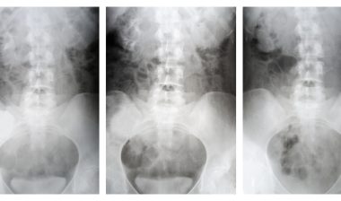 hip xray