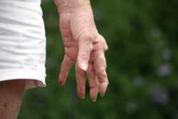 rheumatoid arthritis