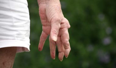 rheumatoid arthritis
