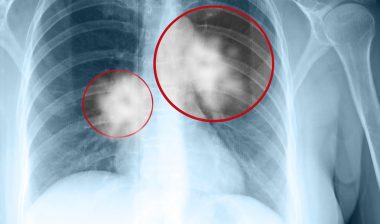 lung cancer, mesothelioma