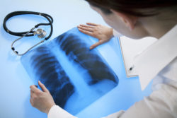 Doctor examines x-ray image of lungs