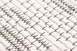 Pradaxa atrial fibrillation ekg bleeding