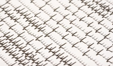 Pradaxa atrial fibrillation ekg bleeding