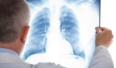asbestos lung cancer doctor chest x-ray