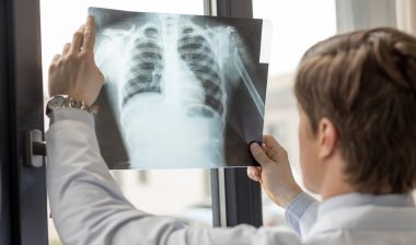 IVC filter Cook Celect complications chest X-ray