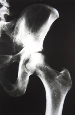 Stryker hip implant LFIT V40 left hip X ray