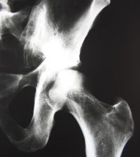 Stryker hip implant LFIT V40 left hip X ray