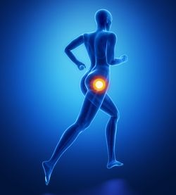 Stryker LFIT V40 femoral head recall hip implant