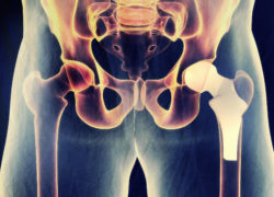 hip replacement