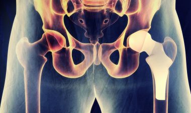 hip replacement