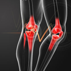 knee implant