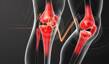 knee implant