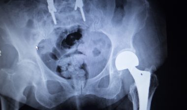 metal hip implant