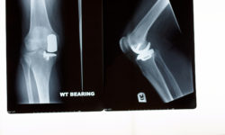 A xray of a partial knee replacement