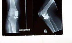A xray of a partial knee replacement