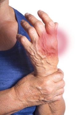Actemra rheumatoid arthritis hand heart failure