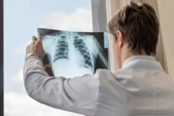 doctor chest xray asbestos lung cancer mesothelioma