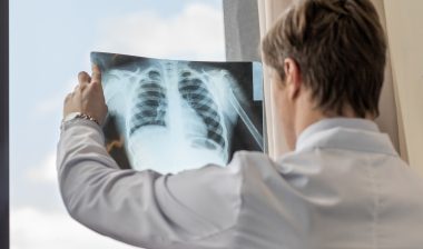 doctor chest xray asbestos lung cancer mesothelioma