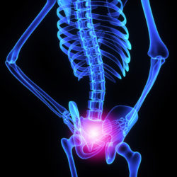 Stryker hip replacement hip implant