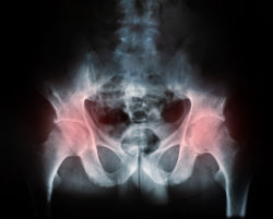 DePuy Zimmer hip implant hip replacement