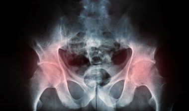 DePuy Zimmer hip implant hip replacement