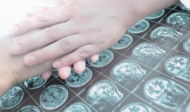 Dilantin cerebellar atrophy MRI