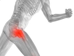 Stryker hip implant hip replacement