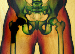 DePuy ASR hip replacement hip implant