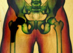DePuy ASR hip replacement hip implant