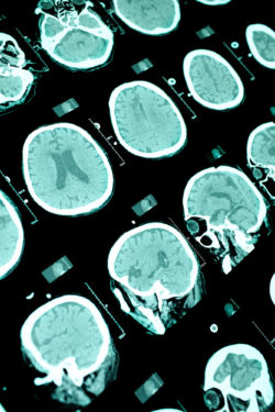 Dilantin epilepsy CT scan head
