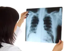 lung xray