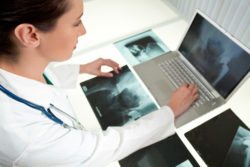 ASR metal on metal hip replacement have led to revision surgeries