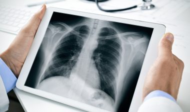 asbestos lung cancer chest X-ray