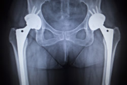 X-ray scan image of hip joints with orthopedic hip joint replacement implant head and screws in human skeleton in blue gray tones. Scanned in orthopedics traumatology surgery hospital clinic.