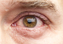 bloodshot eye