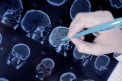 Dilantin cerebellar atrophy epilepsy brain CT scan