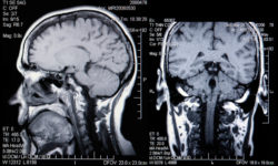 Dilantin cerebellar atrophy brain MRI