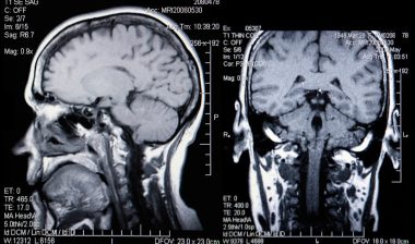 Dilantin cerebellar atrophy brain MRI