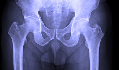 DePuy Zimmer hip implant hip replacement hip X-ray